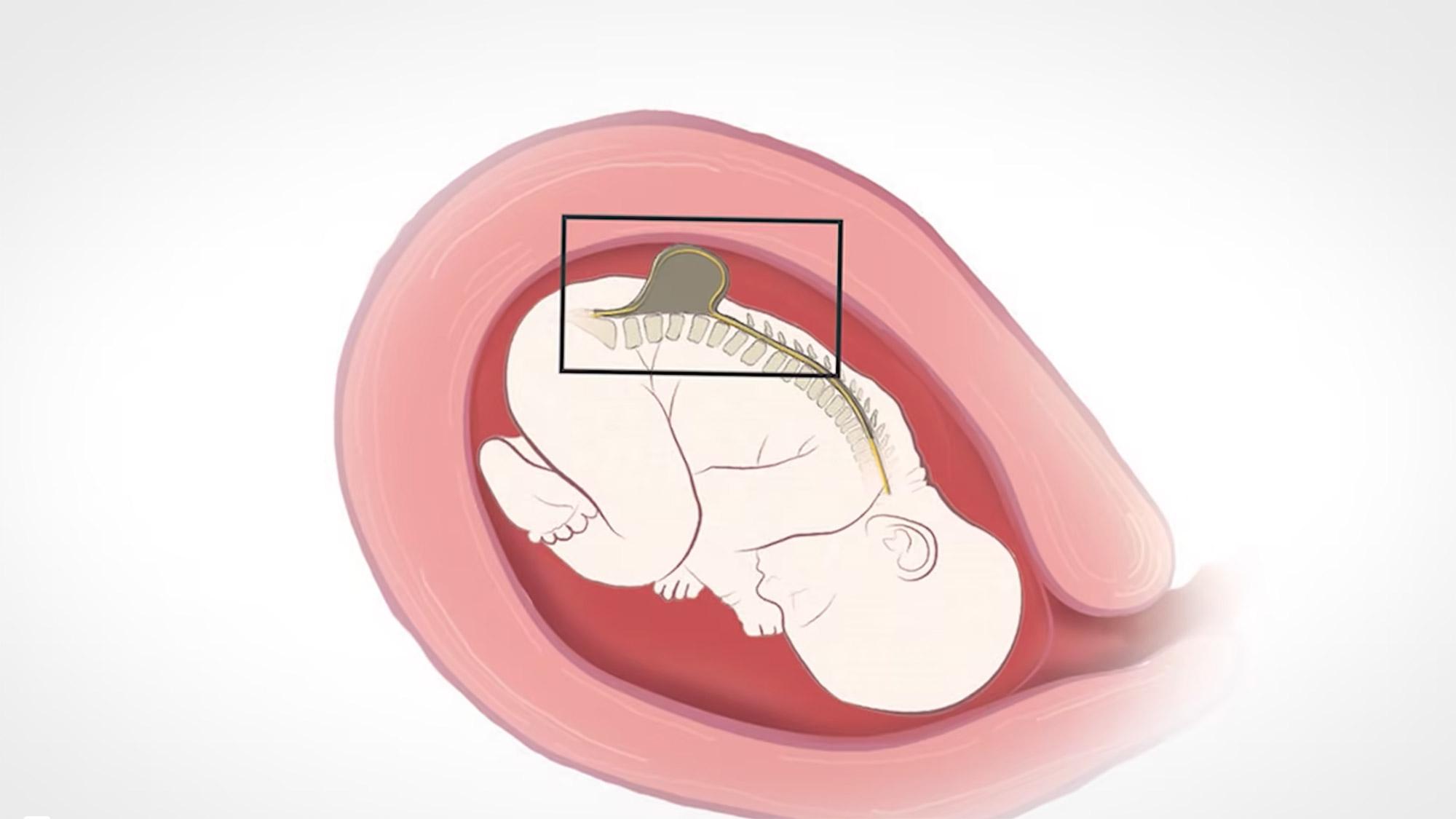 An illustration showing the development of Spina Bifida in the womb