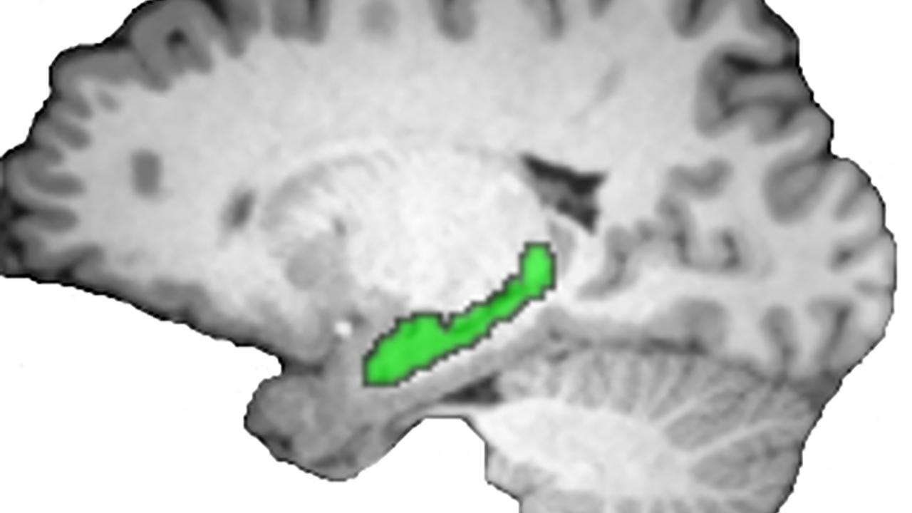MRI image of brain with hippocampus in green