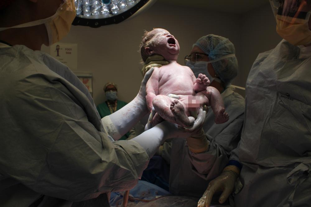 Tobi Maginnis at birth being held up by doctors. He was one of the first babies born after having received stem cells and surgery while in the womb to treat his spina bifida.