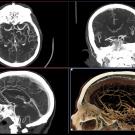 Four images of a human head made by CT imaging. 